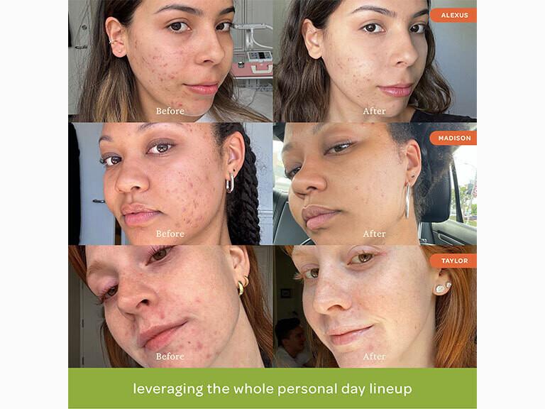 Resized Media/PERSONALDAY DOINGTHEWORKSALICYLICACIDACNETREATMENT FULL ALT6