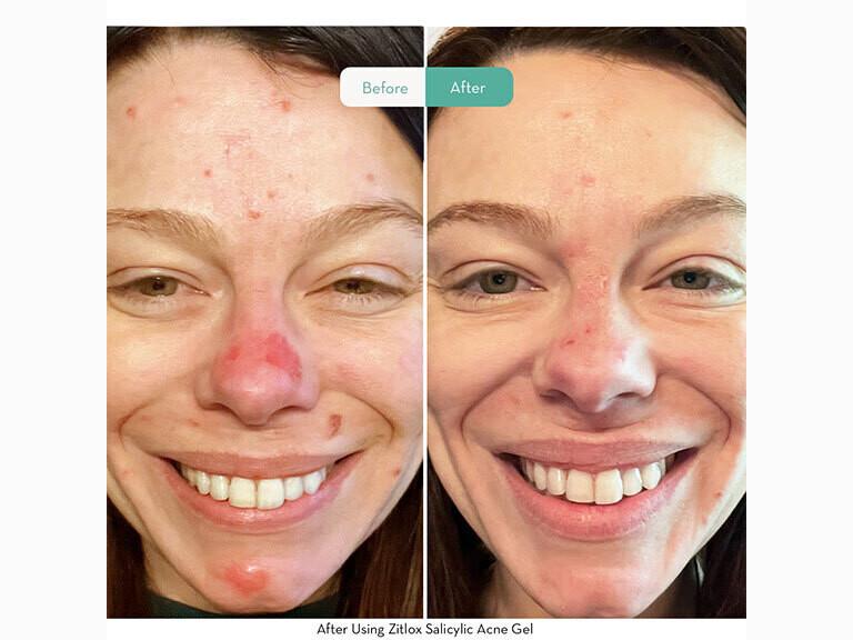 Resized Media/SONAGE ZITLOX SALICYLIC ACNE GEL LIFESTYLE2