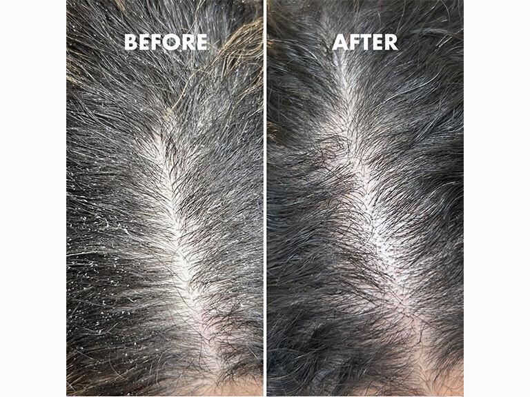 Resized Media/UGHCHCL1068214 Scalp Scrub Before After